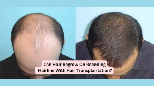 Can Hair Regrow On Receding Hairline With Hair Transplantation?