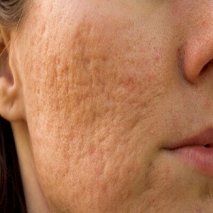 From Scars to Smoothness: Acne Scar Treatments in Dubai