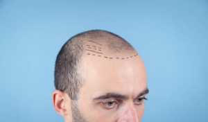 Planning Your Budget: Estimating Hair Transplant Costs in Riyadh