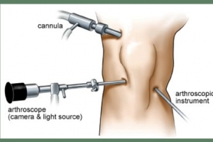  Arthroscopy Surgery in Jaipur