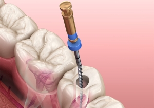 Root Canal Treatment: Dubai's Latest Innovations