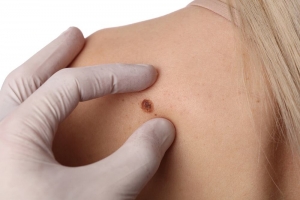 The Ultimate Guide to Safe and Effective Skin Tag Removal