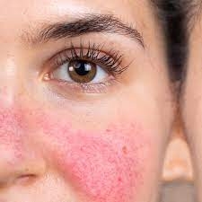 Understanding Rosacea: Causes, Symptoms, and Triggers