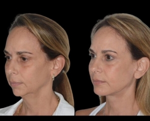 Before and After Real Results of Chin Liposuction in Dubai