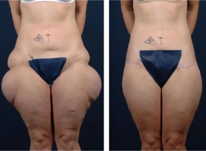 Benefits of Thigh Lift Surgery in Dubai