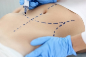Exploring Non-Invasive Liposuction Alternatives in Riyadh: Is Surgery Always Necessary?