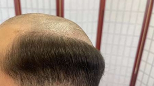 Say Goodbye to Baldness: How Hair Replacement Services Can Change Your Life