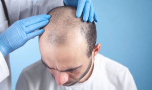 Is Hair Transplant in Riyadh Right for You? Assessing Candidacy and Expectations