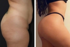 How to Avoid Complications During Buttock Fat Transfer in Dubai