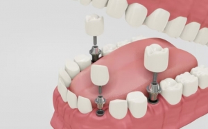 Beyond Dentures: Why Dental Implants Are the Superior Choice