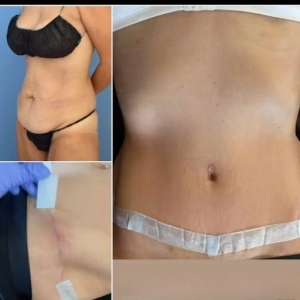 The Role of Social Media in Promoting Mini Tummy Tuck