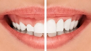 Transform Your Smile in Just One Day: The Ministry of Smile 1-Day Smile Makeover