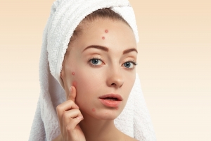 5 Ways Tretinoin Can Help Clear Hormonal Acne