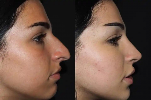 Unraveling Dubai's Expertise: The Art of Nose Reshaping 