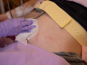 Managing Epidermoid Cysts: From Diagnosis to Recovery