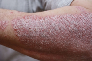 Psoriasis: Managing Flare-Ups in Dubai