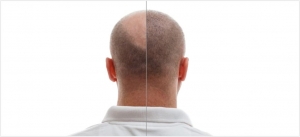 Why Do Most Men Need a Hair Transplant?