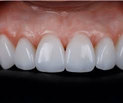 Dubai's Top Choice for E-Max Veneers: Get Your Dream Smile