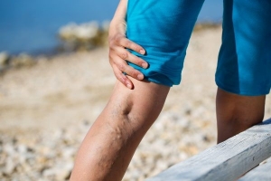 What Are The Prominent Reasons For Varicose Veins?