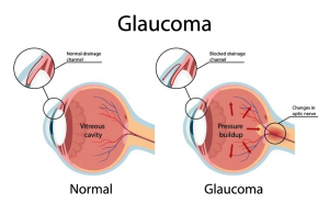 The Role of Glaucoma Implants in Refractory Cases