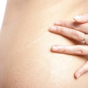 Enhancing Beauty, Minimizing Scars: Surgical Scar Revision Options in Dubai
