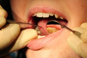 The Functional Benefits of Braces Treatment