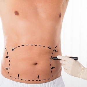 Tummy Tuck Recovery: What to Expect After the Procedure in Dubai