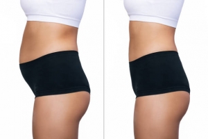 Buttock Augmentation: Muscat's Cost-Effective Beauty Solutions