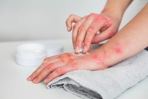 Understanding Lichen Planus and How Homoeopathy Can Help