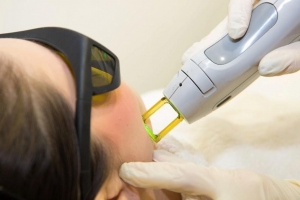 Laser Hair Removal Market 
