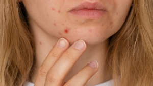 A Full Guide on How to Get Rid of Pimples | Dubai Beauty