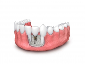 Enhancing Dental Implant Longevity with Bone Grafting