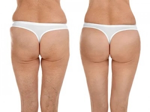 Overview of Brazilian Butt Lift (BBL) Procedures in Dubai