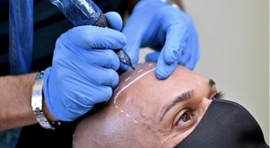 Transform Your Look with Hair Tattoo in Vancouver: Scalp Micropigmentation by Rob James