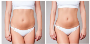 Top Aspects for A Higher Success Rate of Non-Surgical Body Contouring