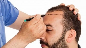 What to expect after hair restoration?