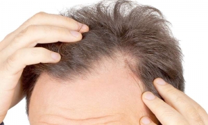 Which Type of Doctor Is Best for Hair Fall?