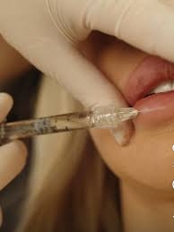 Botox Lip Flip in Dubai: A Non-Invasive Lip Enhancement