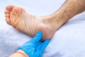 Navigating Diabetic FootCare at Home in Dubai