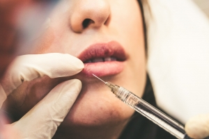 Lip filler injection