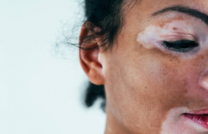 Vitiligo Relief: Opzelura's Topical Treatment in Riyadh