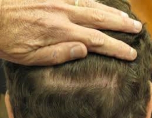 Can hair regrow on a scarred scalp?