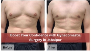 Boost Your Confidence with Gynecomastia Surgery in Jabalpur