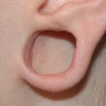 Transform Your Profile: Earlobe Surgery in Riyadh