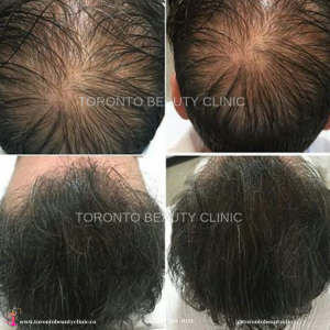 Top 5 Benefits Of Hair Fall PRP Treatment