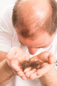 Facing Hair Loss? Hair Systems Offer An Alternative To The Cure For Baldness