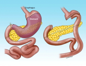 What is Colon Cancer and how can we treat it?