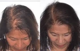 Laser Hair Therapy for Hair Loss: What You Need to Know