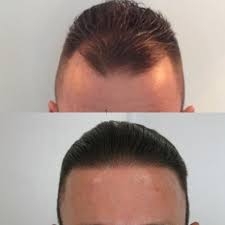 When Is the Best Time to Get a Hair Transplant in AL?