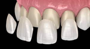 Achieving a Perfect Smile: How Dental Veneers Can Transform Your Look